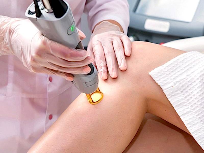 Что такое лазерная эпиляция?
